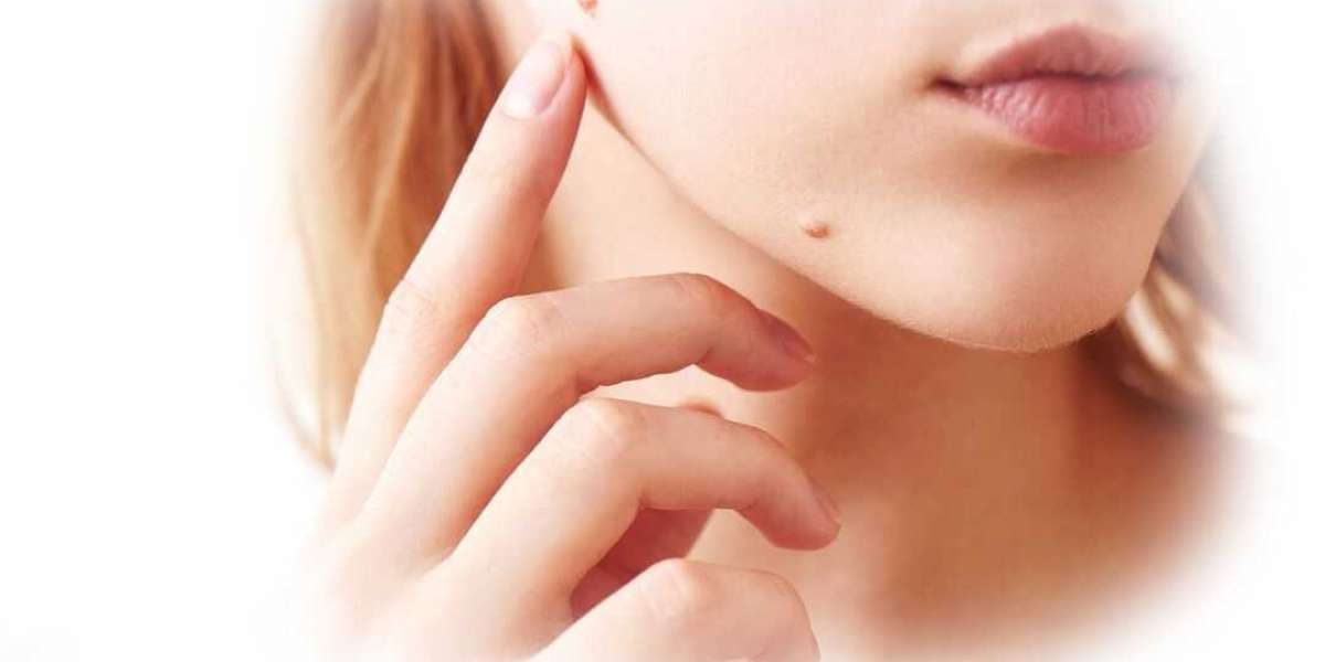 Dose It Work Or Not Amarose Skin Tag Remover?
