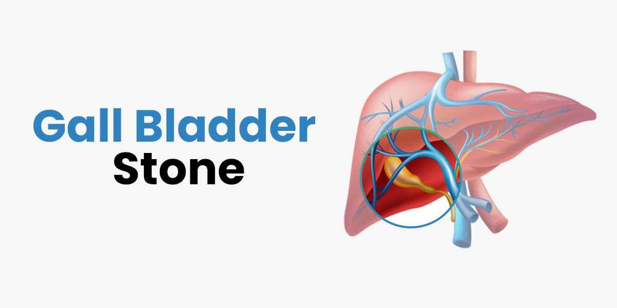 How Risky is Gallbladder Stone (Gallstones)?
