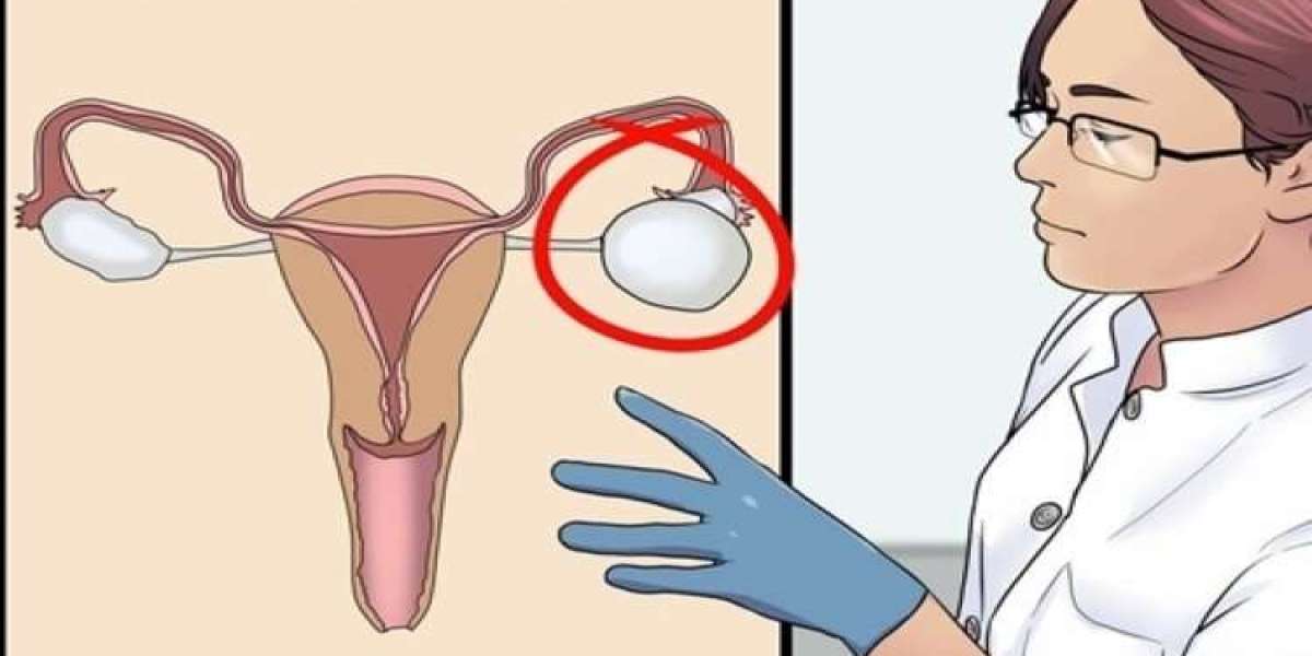 Các phương pháp chẩn đoán và điều trị u nang buồng trứng