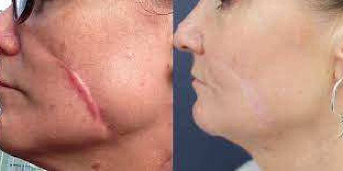 The Ultimate Guide to Scar Removal at ReNew Clinic