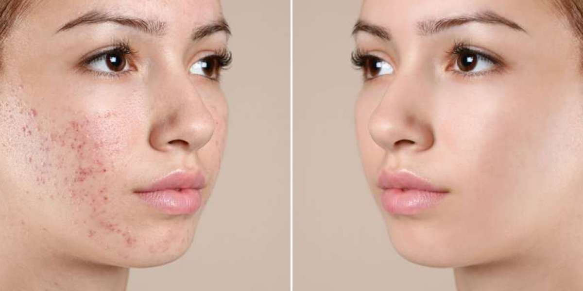 Discover the Art of Enhancing Beauty: Non-Surgical Rhinoplasty in Dubai