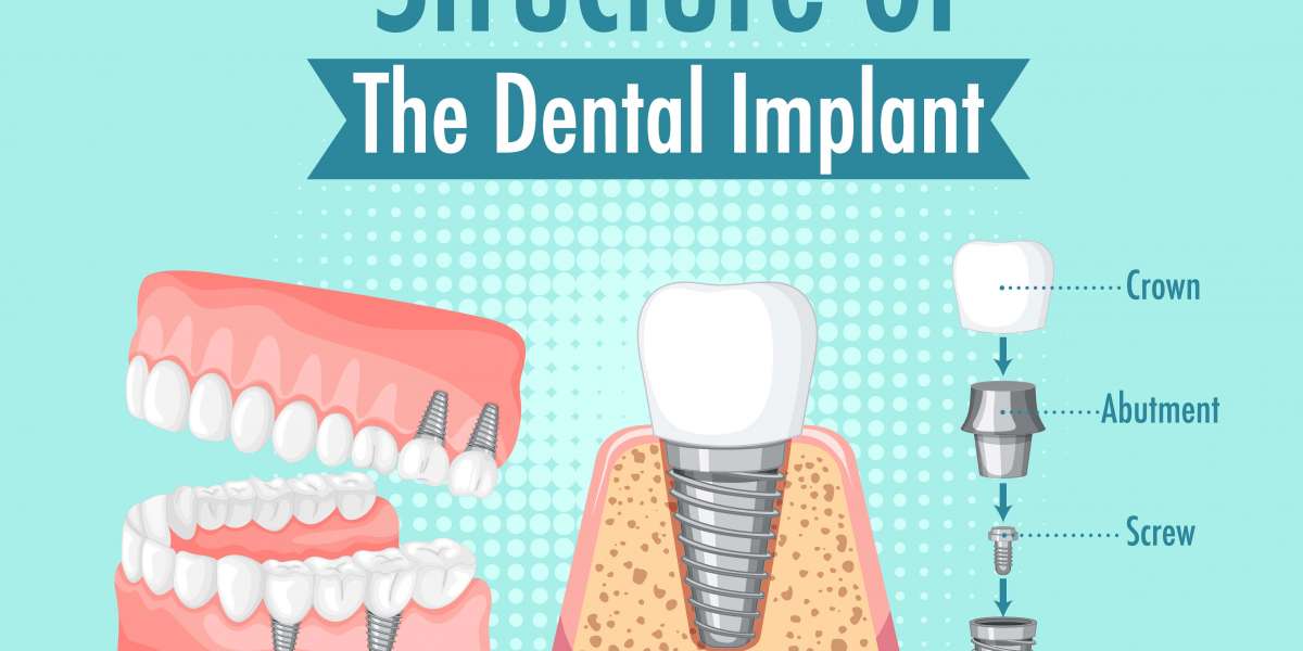 Smile Confidently With All-on-4 Implants
