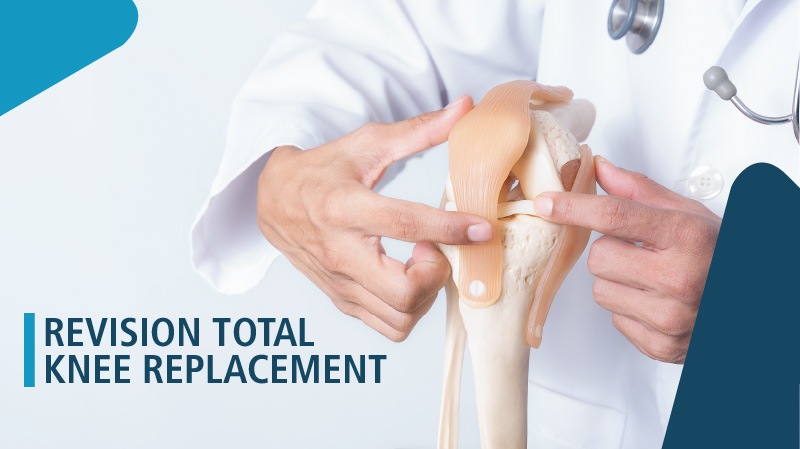Choosing the Right Surgeon for Your Revision Total Knee Replacement in Delhi