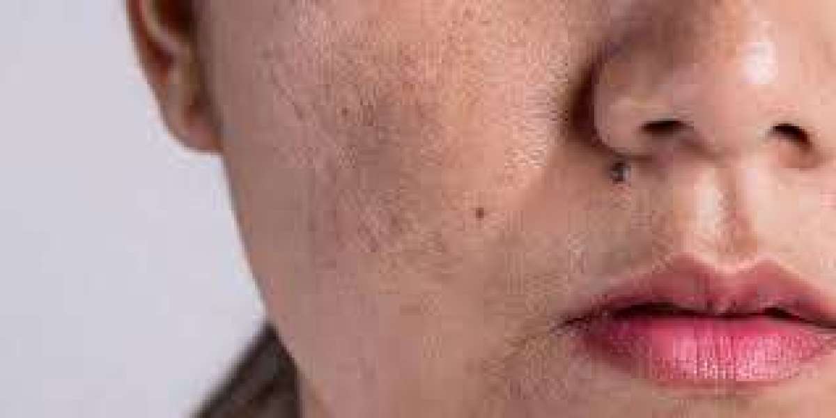 Effective Acne Treatment Solutions in Noida