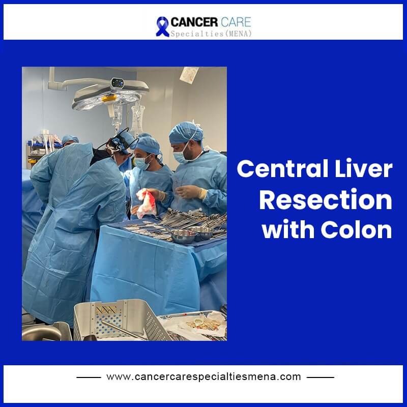 Liver cancer Surgery In baghdad | Best Liver Surgeons Iraq