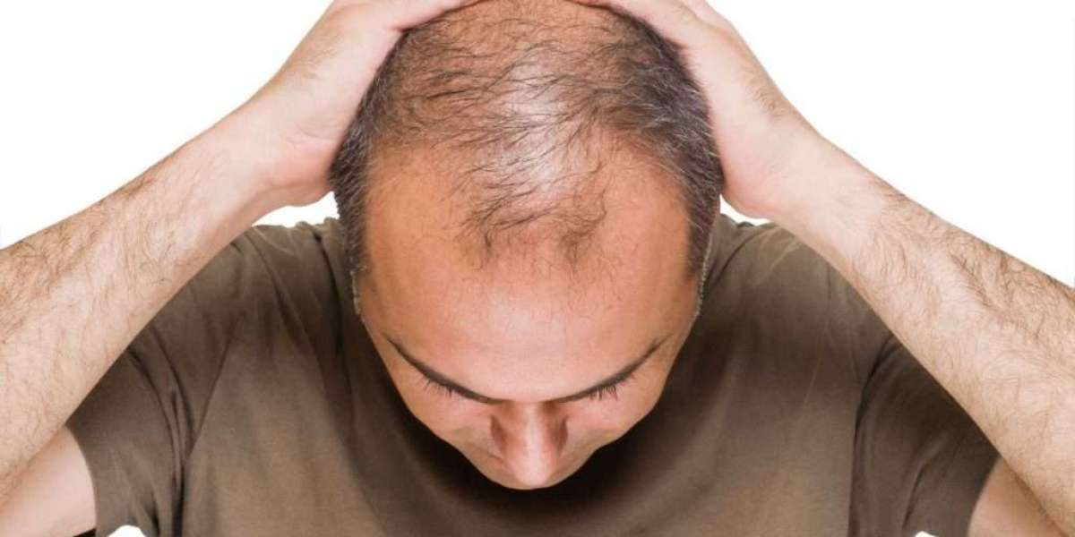 The Growing Minoxidil Market is driven by Rising Prevalence of Hair Loss Issues