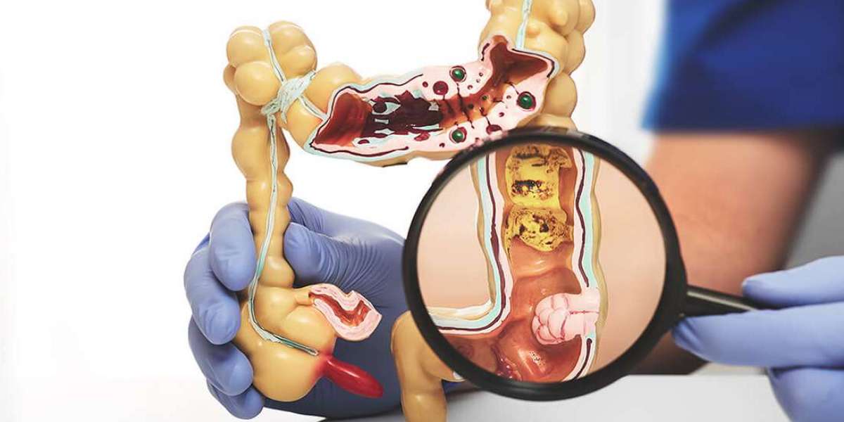 The Ultimate Guide to Finding the Right Colorectal Surgeon Mumbai