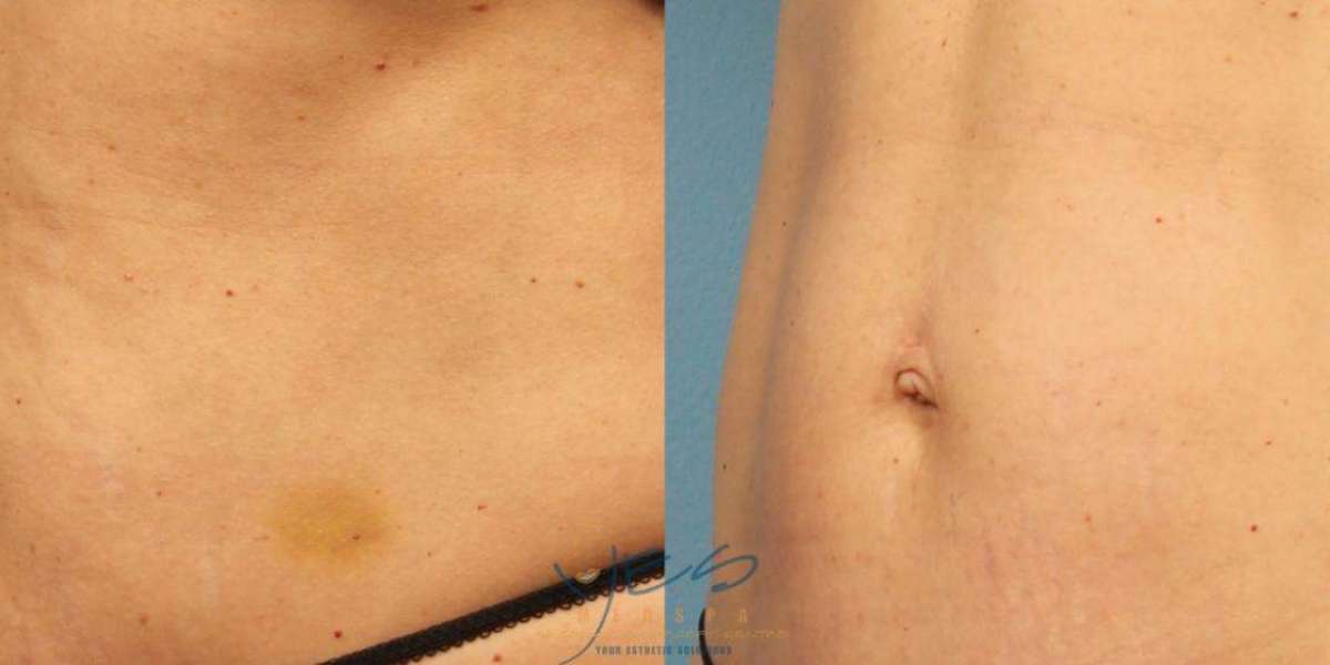 Transform Your Tummy: Real Results from Morpheus8 Skin Tightening